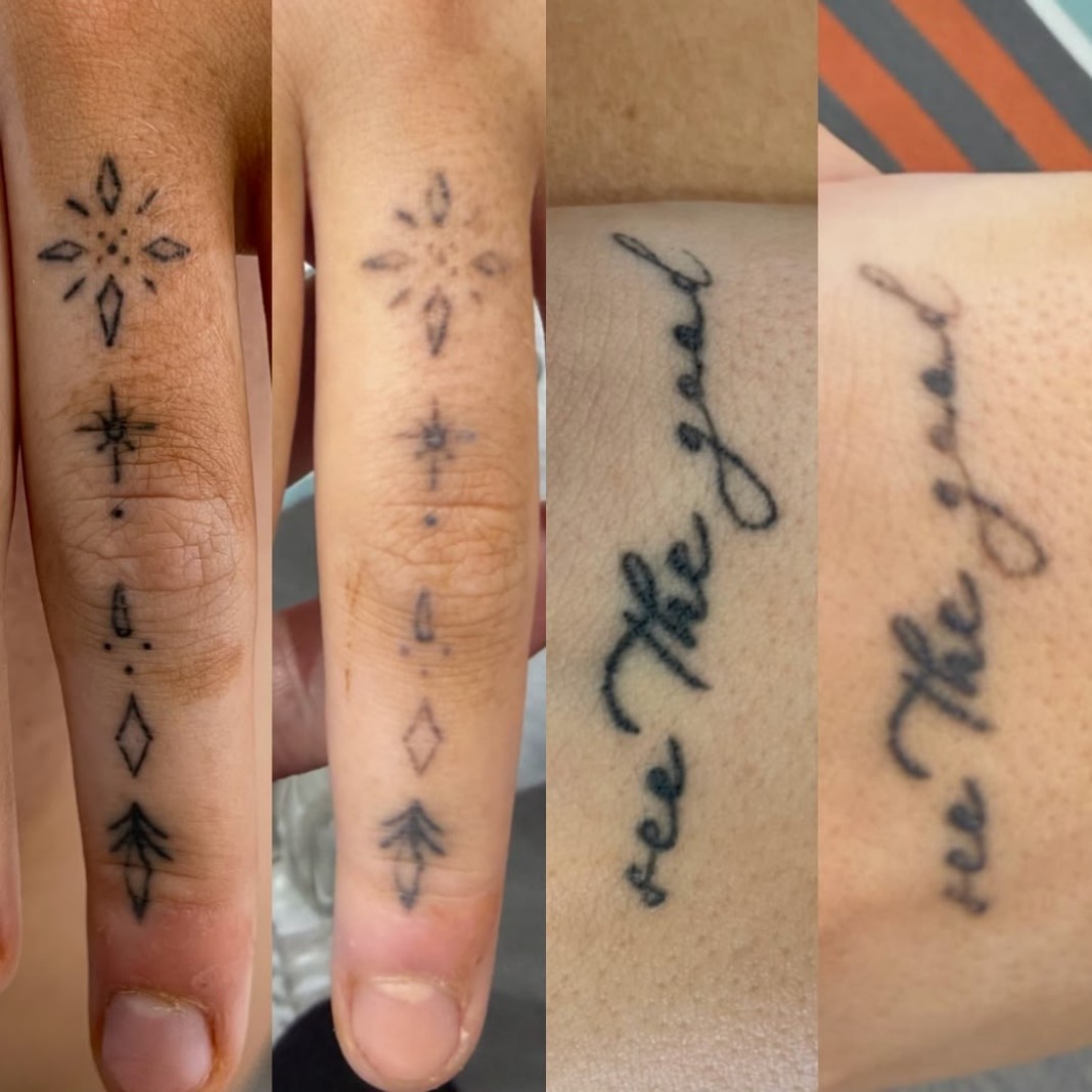 tattoo removal